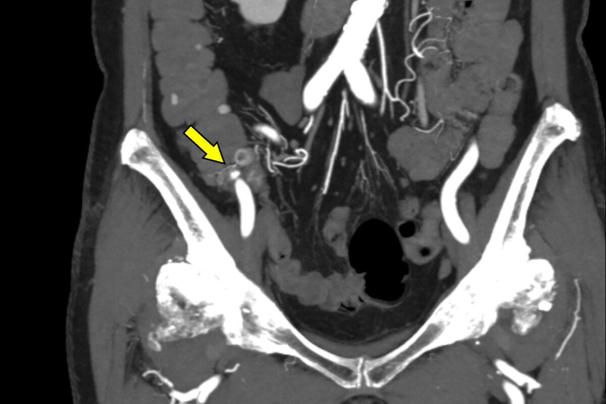 図4．冠状断像MIP、動脈相