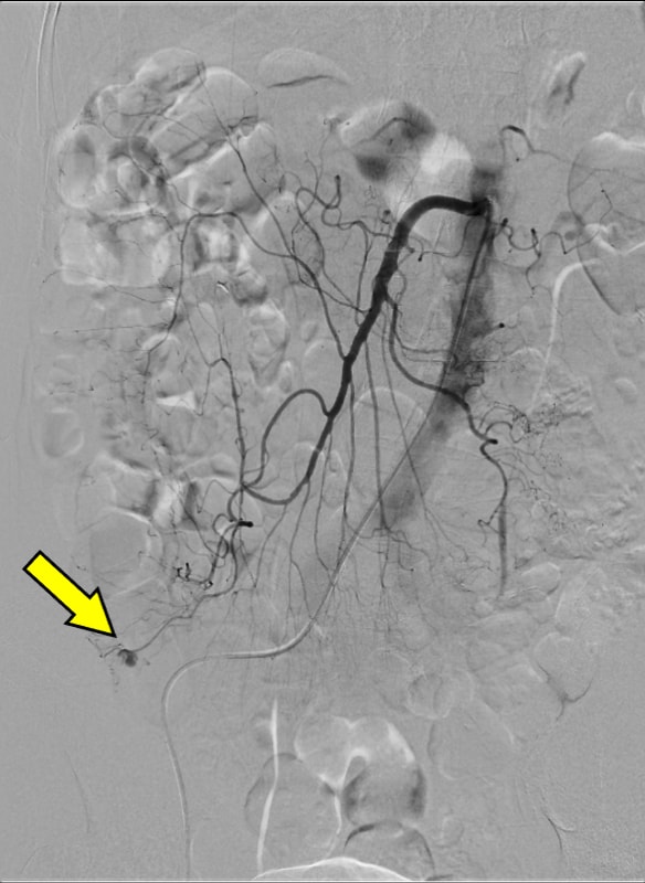 図5．血管造影、上腸間膜動脈造影