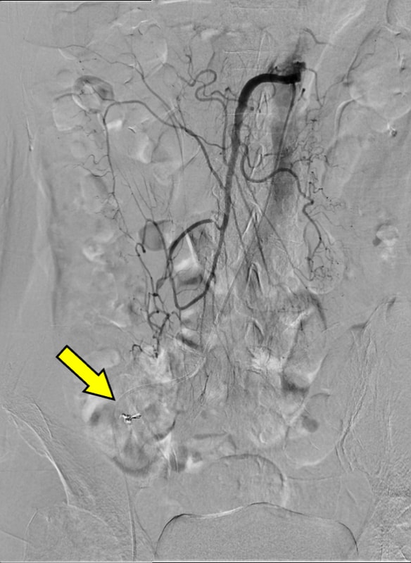 図6．血管造影、上腸間膜動脈造影