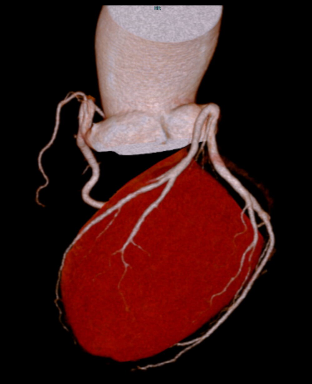 図1.心臓CTボリュームレンダリング画像