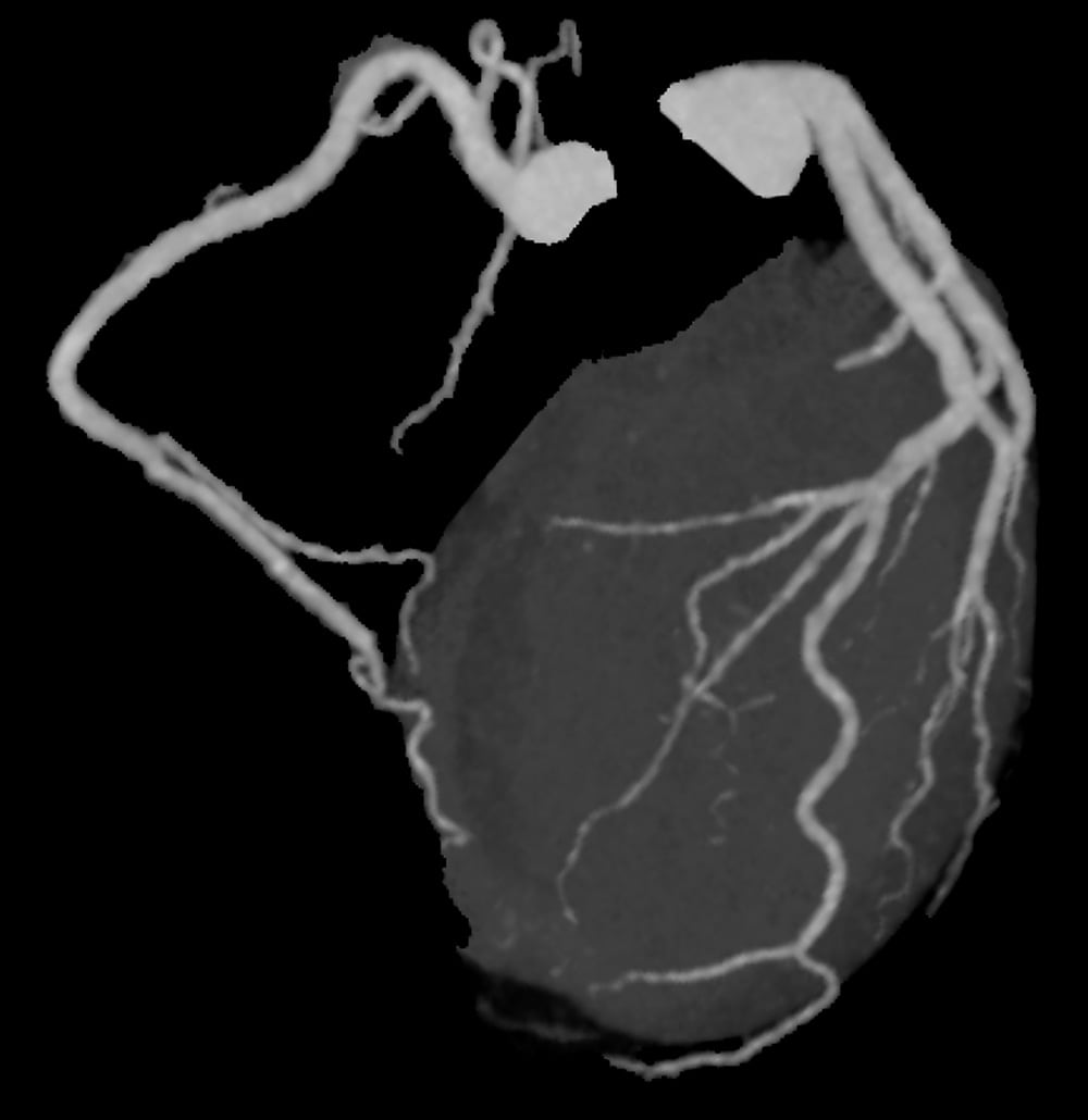 図2.心臓CT 冠動脈Angiographic view
