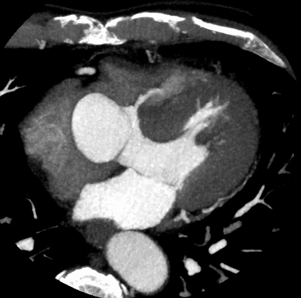 図3.心臓CT MIP axial画像(収縮末期)