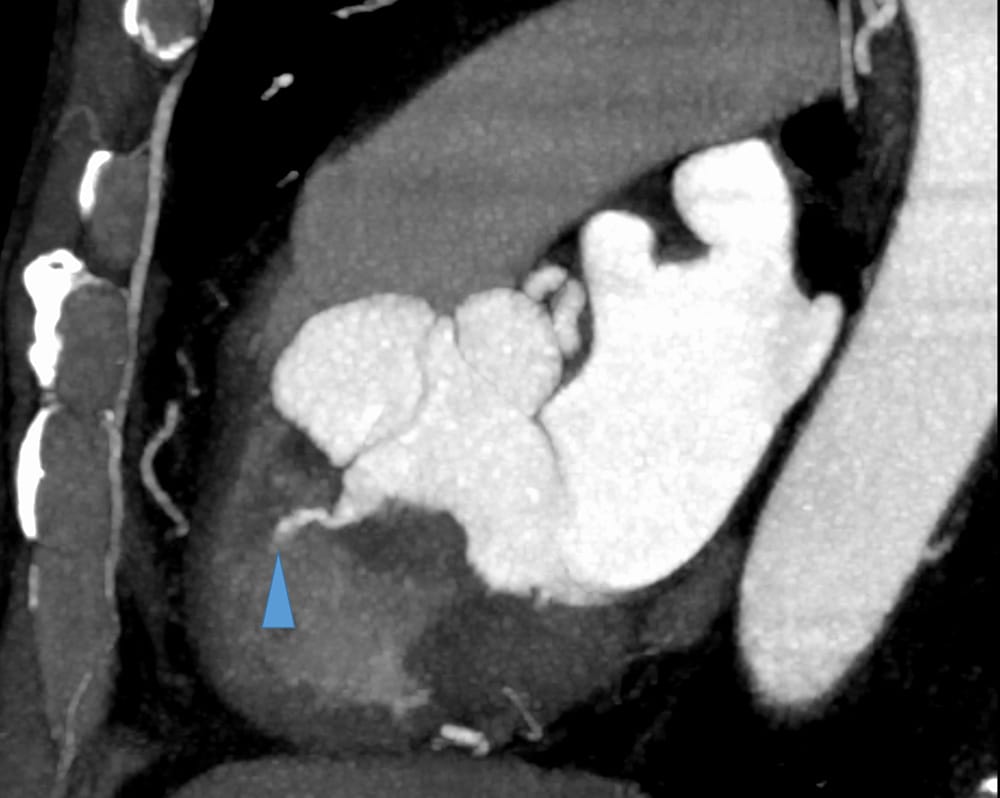 図4.心臓CT MIP MPR画像(収縮末期)