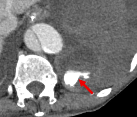 図3．造影後期相