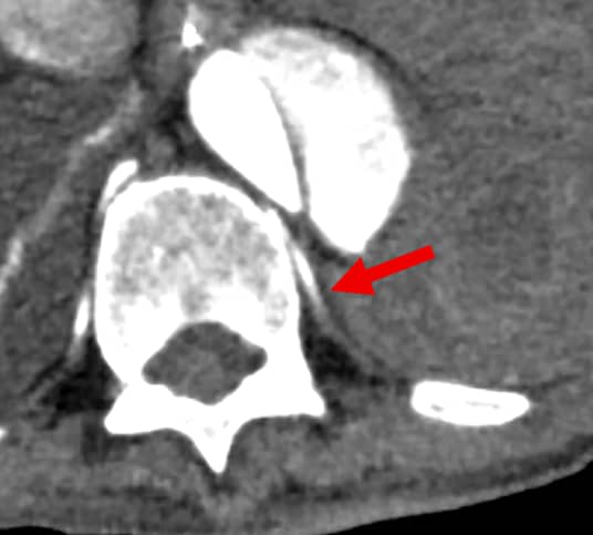 図4．造影早期相、責任血管