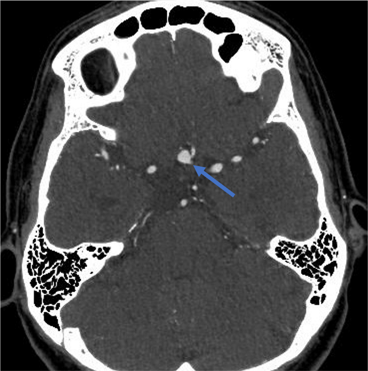 図1．頭部CTA 横断像