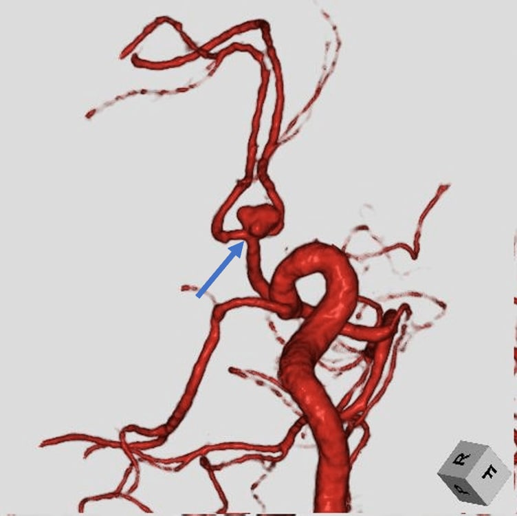 図2．頭部CTA VR画像 (Volume Rendering Image)