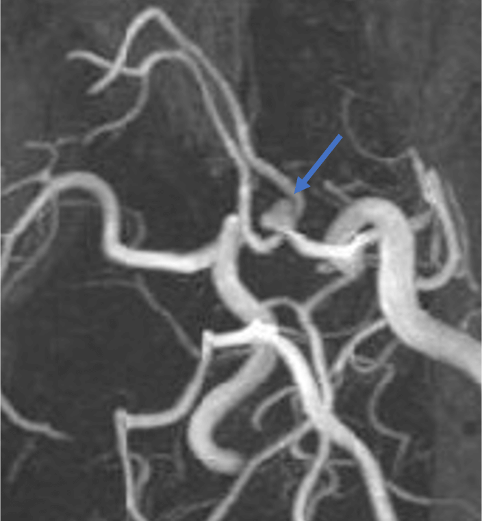 図3．頭部MRA MIP画像 (Maximum Intensity Projection Image)