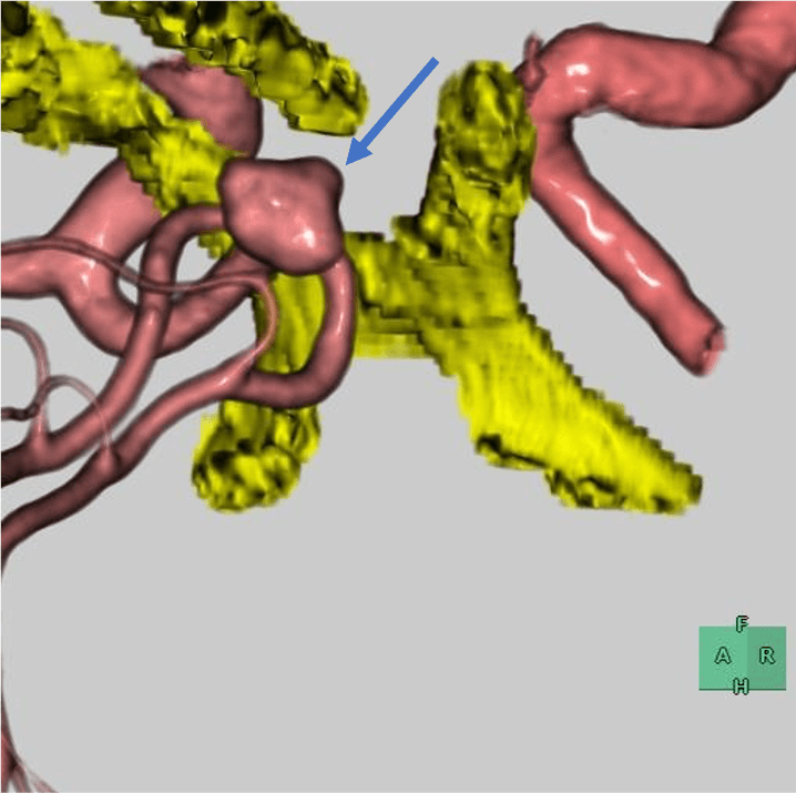 図4．頭部CTA VR画像 拡大像　(Volume Rendering Image)
