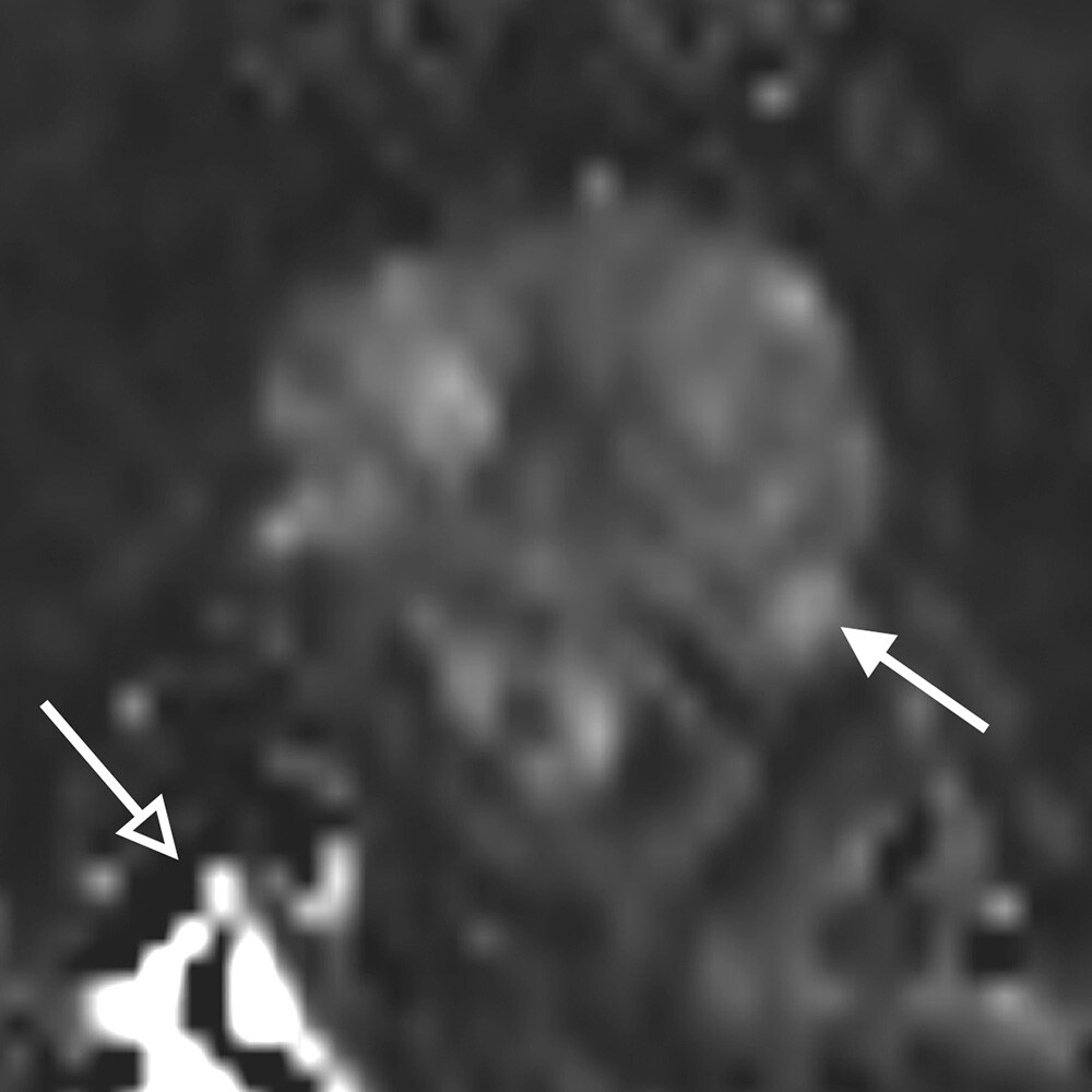 図１．拡散強調像(b=2,000) 1か月前