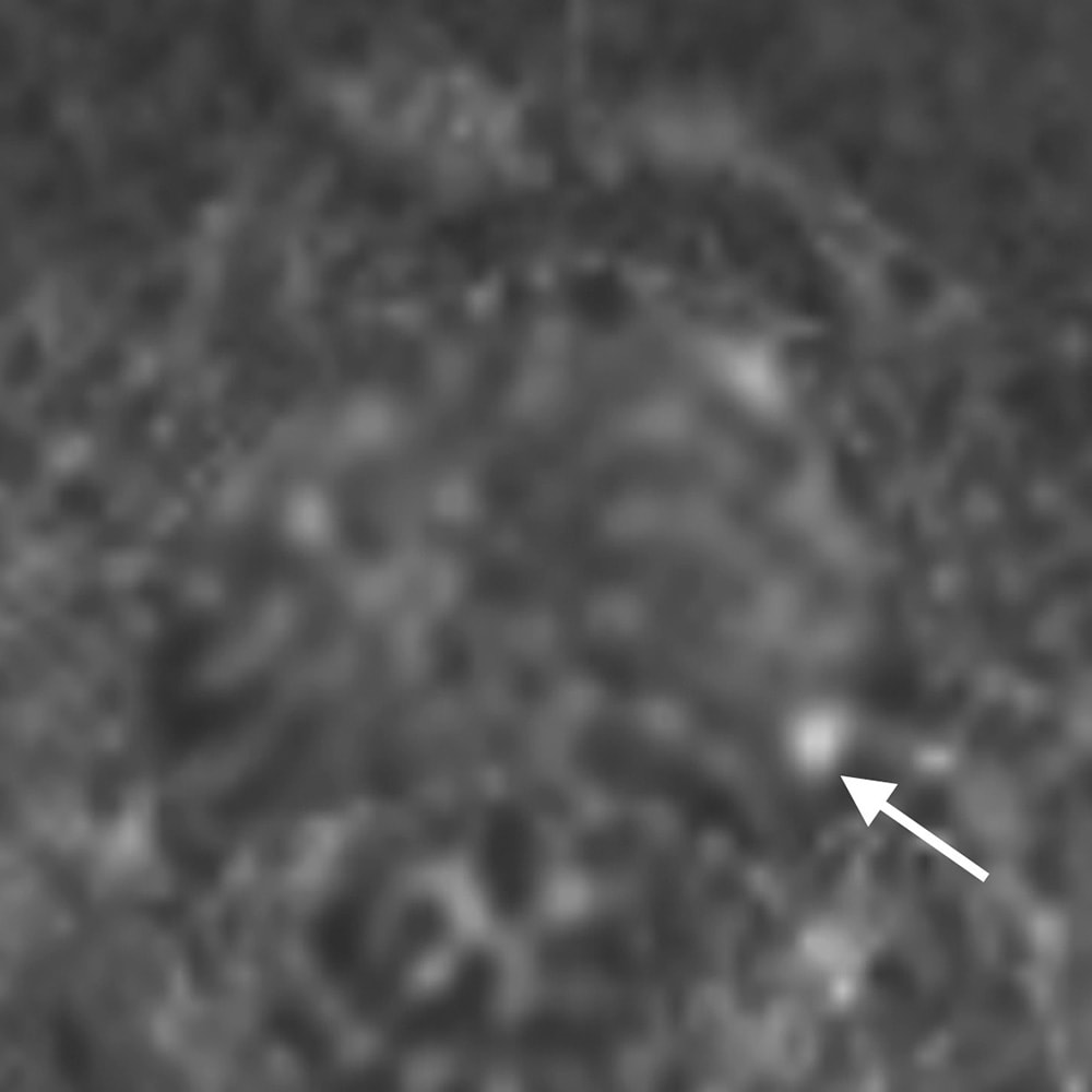 図2．拡散強調像(b=2,000)