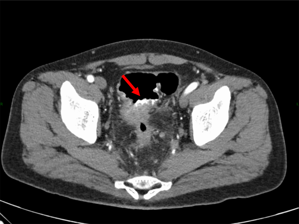 図1．単純（120kVp画像）、水平断