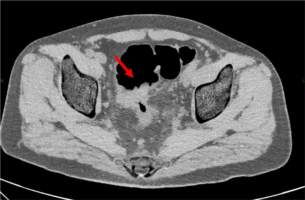図2．単純（Calcium Suppression画像）、水平断
