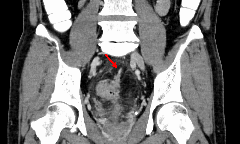 図3．門脈相（120kVp画像）、冠状断