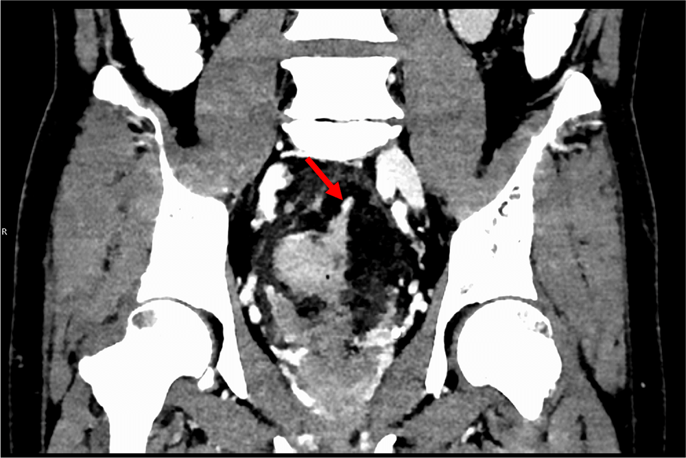 図4．冠状断像MIP、動脈相