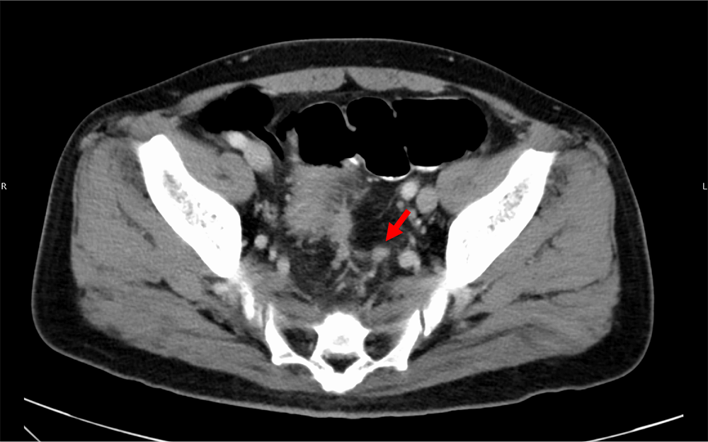 図5．門脈相（120kVp画像）、水平断