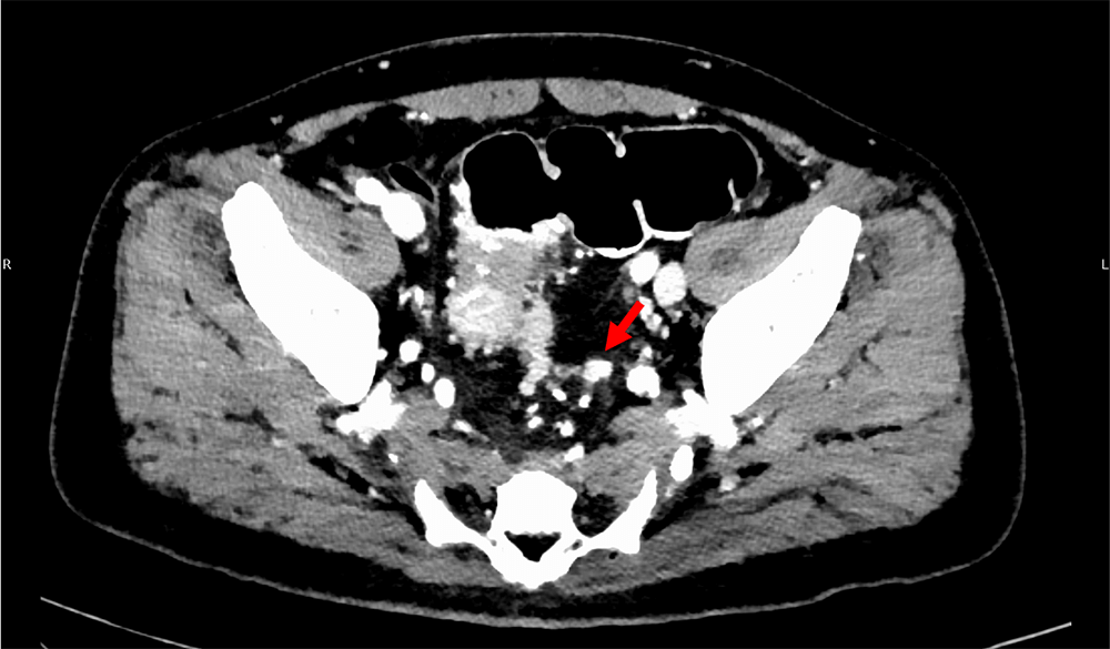 図6．門脈相（120kVp画像）、水平断