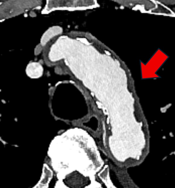 図1．大動脈造影CT水平断