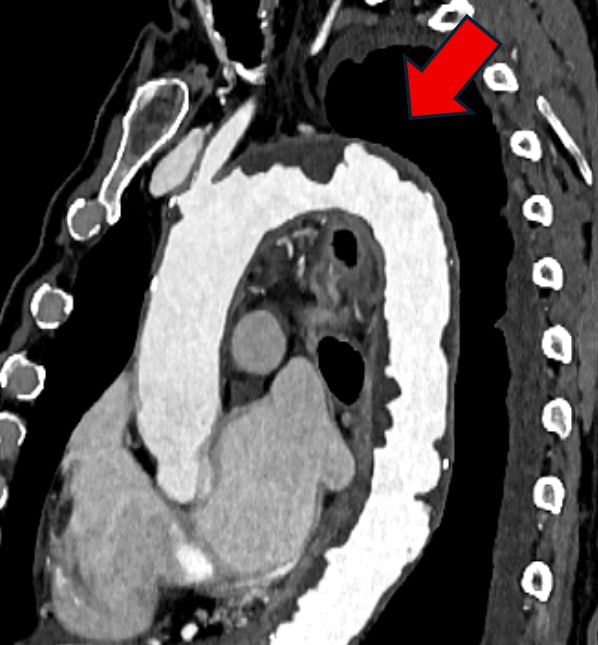 図2．大動脈造影CT MPR像