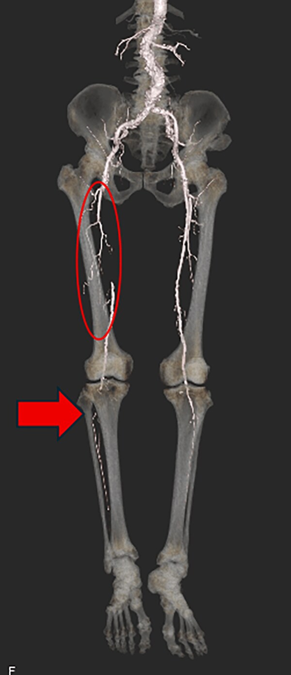 図3．大動脈~両下肢動脈3D-CTA VR像