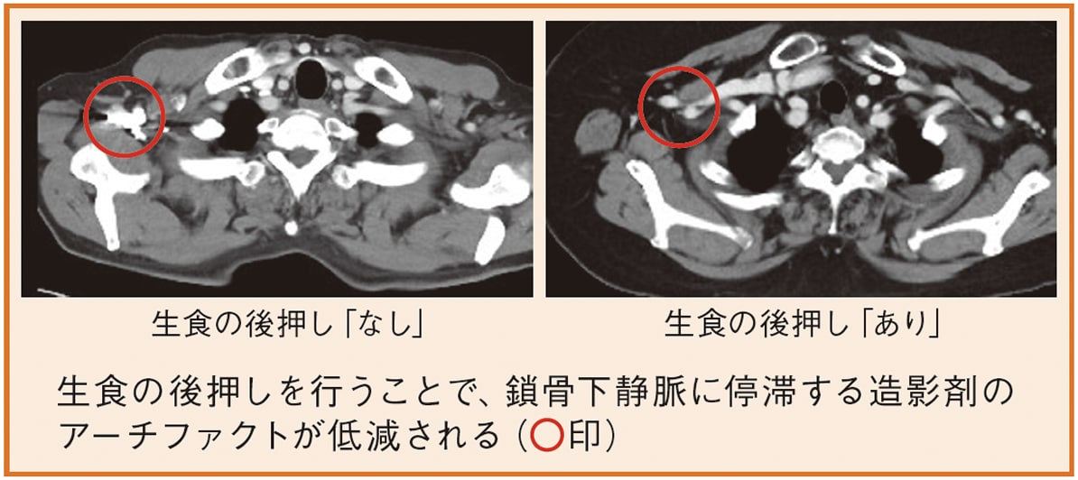 生食の後押し効果（鎖骨下静脈のアーチファクト）