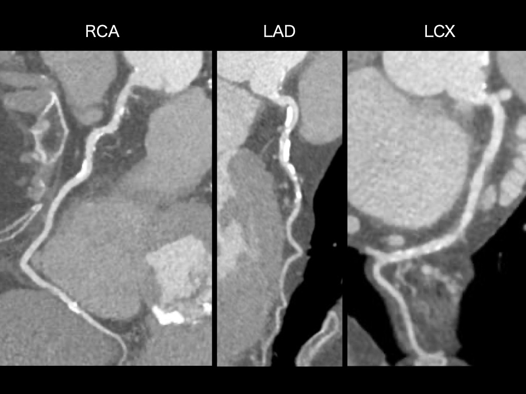 図4．動脈相RCA、LAD、LCX