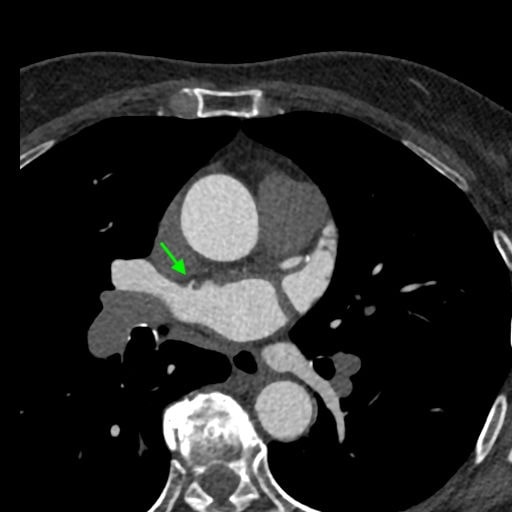 図5．左房から細い血管構造