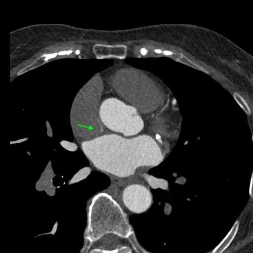 図6．左房内への造影剤ジェット疑い