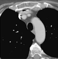 Centargo CTインジェクションシステムの革新的エアマネジメント 空気の混入がもたらすリスクとCentargoの革新