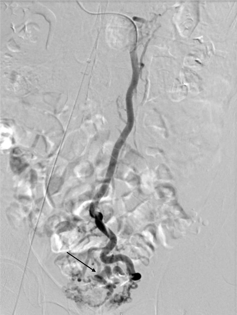 図1．塞栓前下腸間膜静脈造影