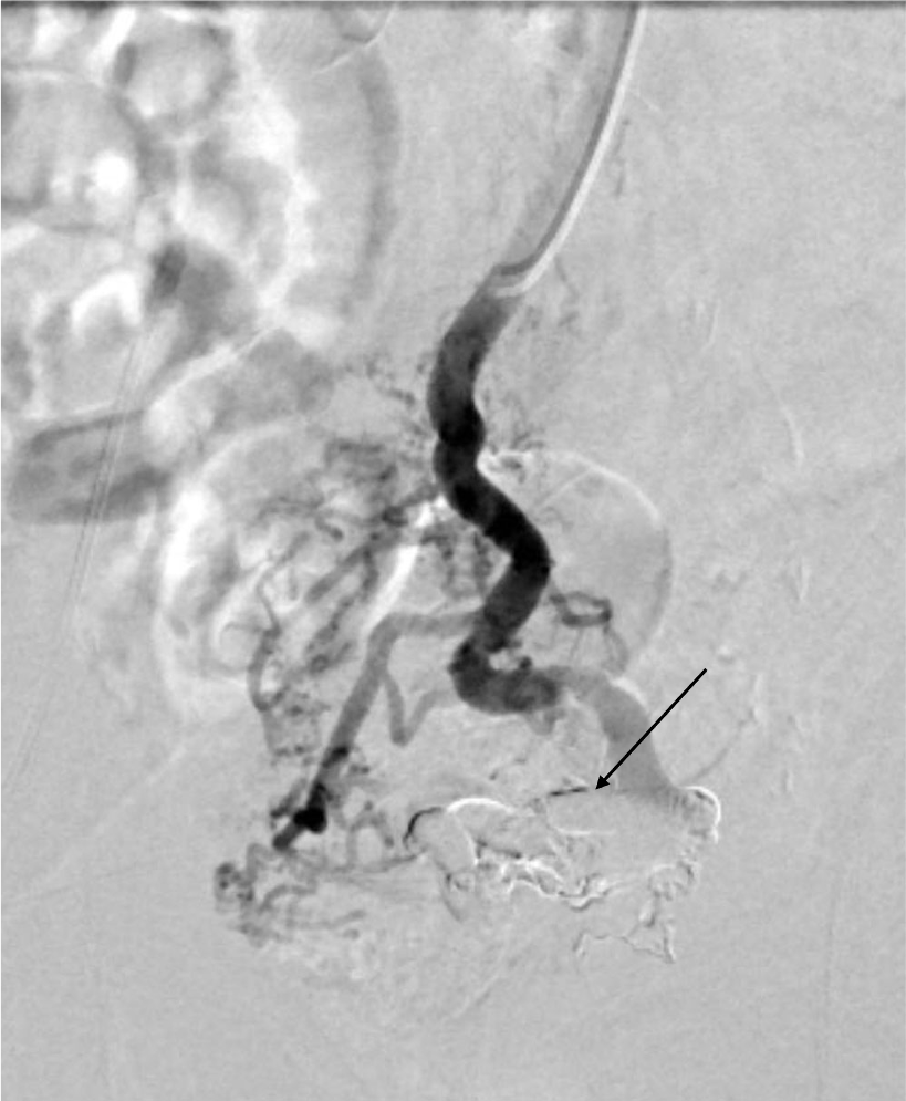 図2．塞栓後下腸間膜静脈造影