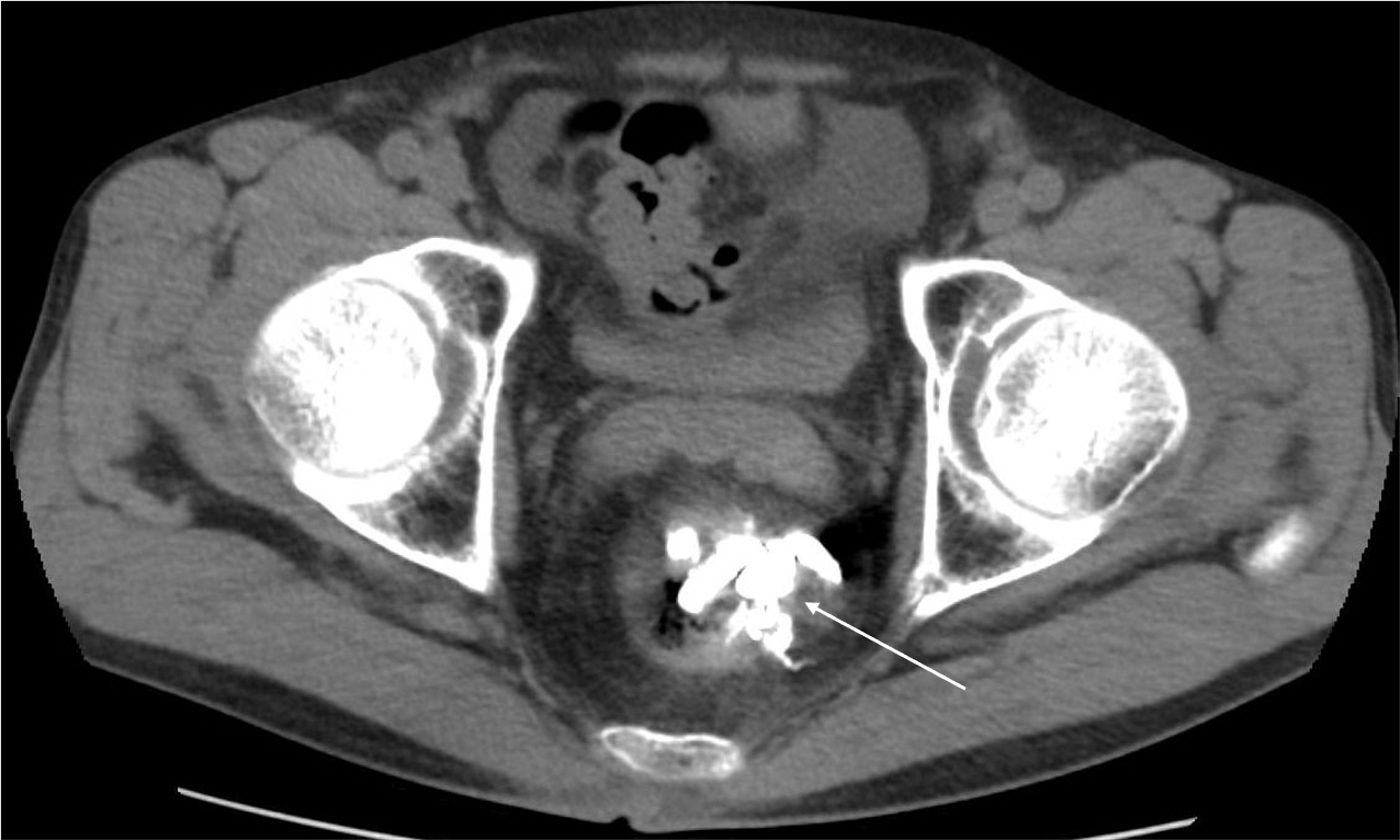 図3．治療後単純CT軸位断像