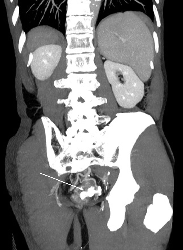 図4．治療後造影CT冠状断slab MIP像