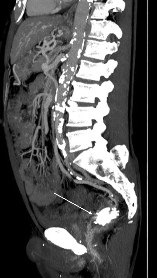図5．治療後造影CT矢状断slab MIP像