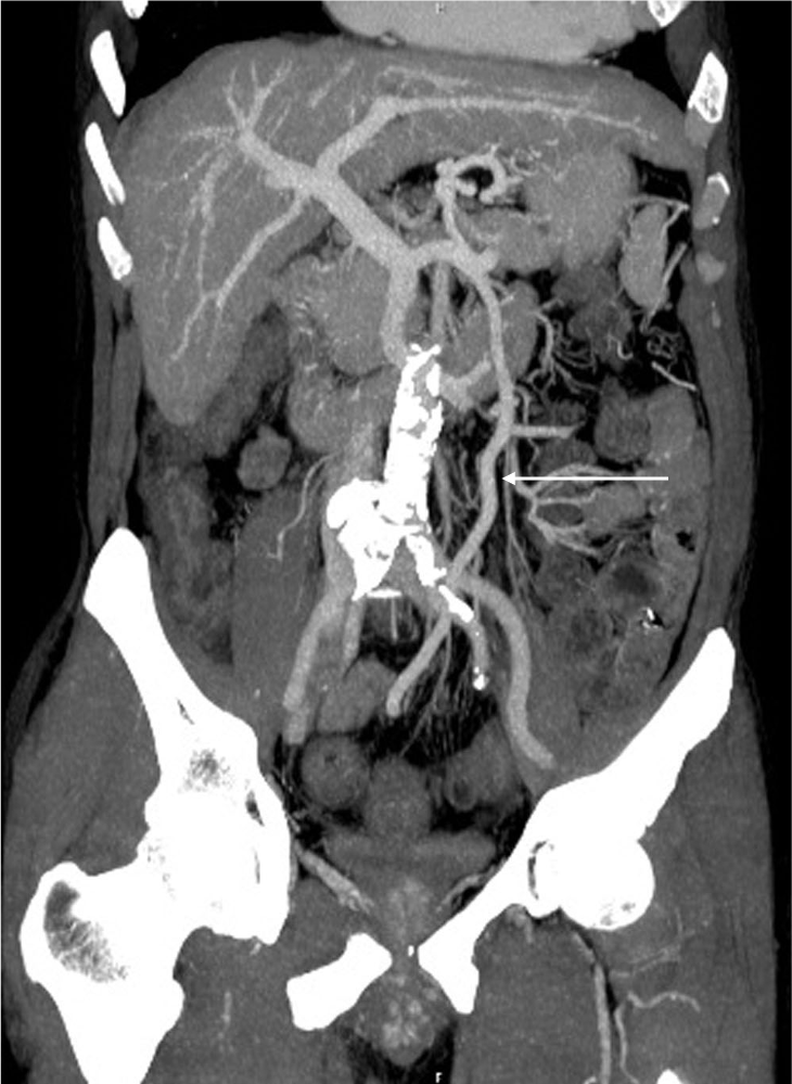 図6．治療後造影CT MPR slab MIP像
