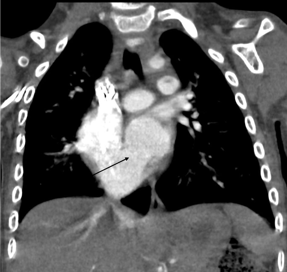 図2．造影CT冠状断像