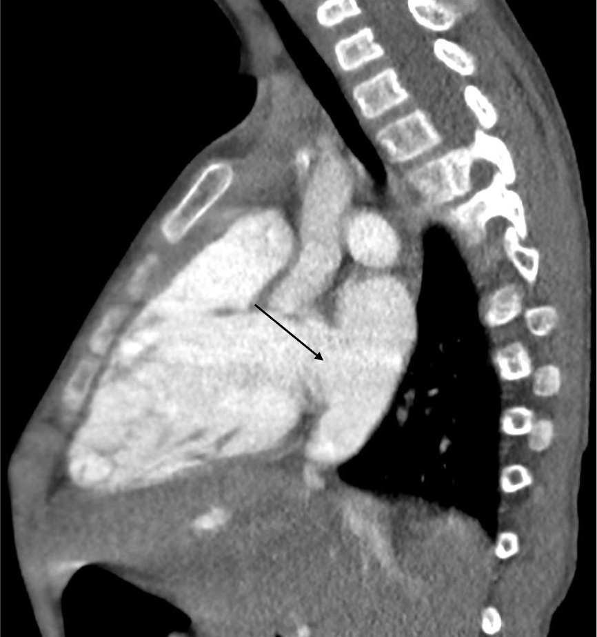 図3．造影CT矢状断像