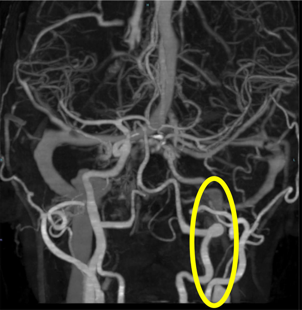 図1．頭部CTA　MIP像
