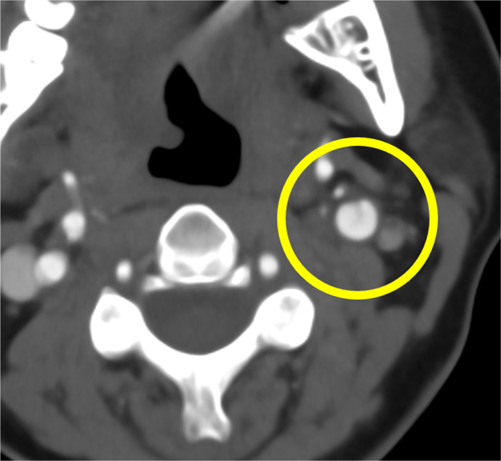 図2．頭部CTA　C2下端レベル