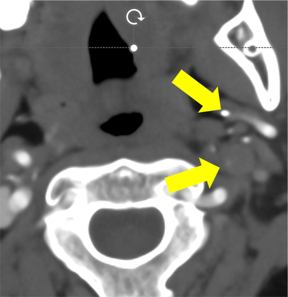 図3．頭部CTA　C2中央レベル