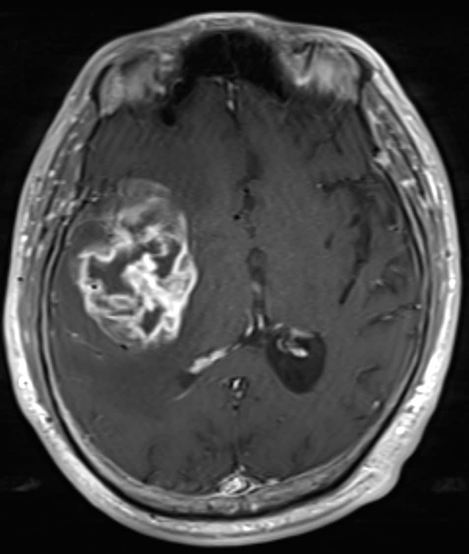 図2．造影T1強調像