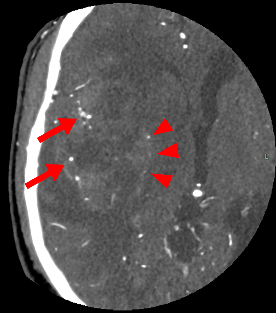 図3．CTA　横断像