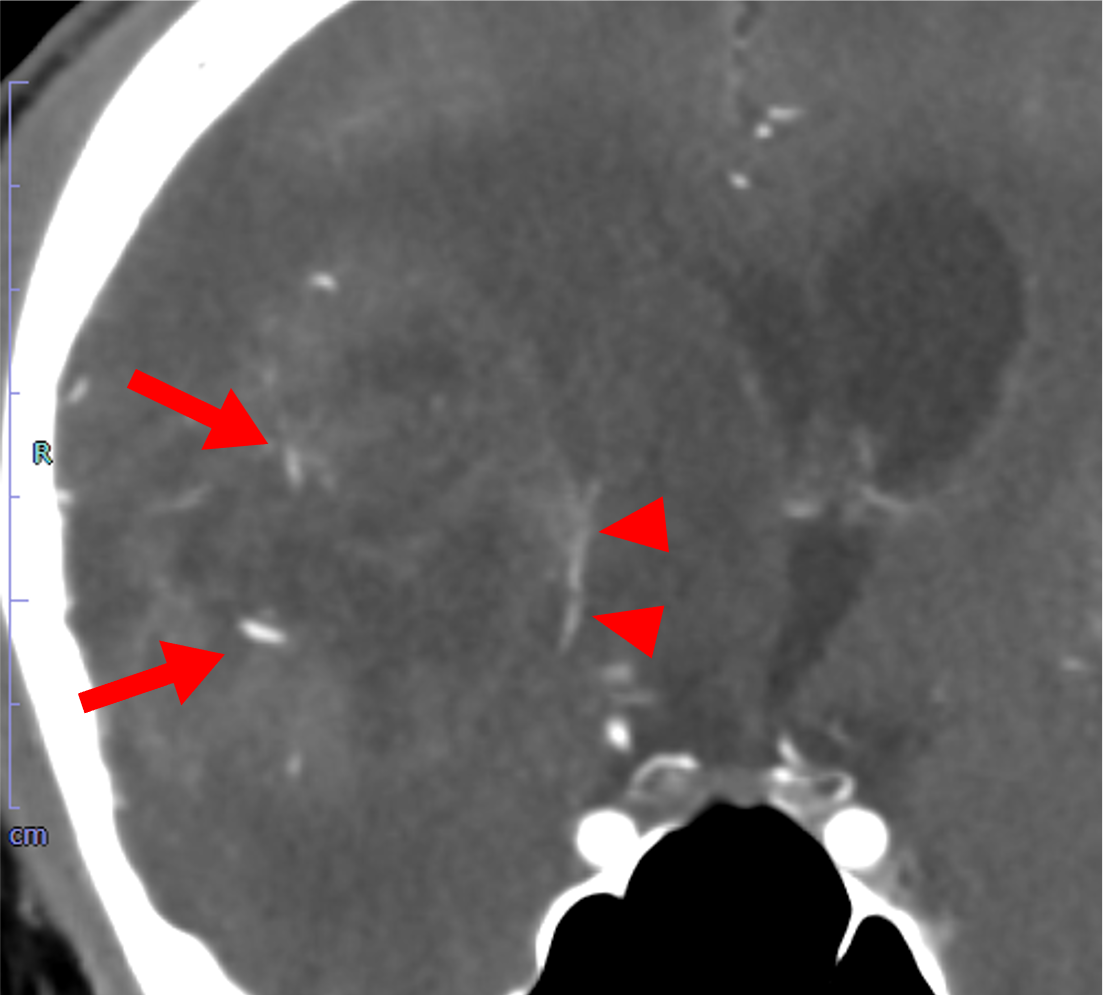 図4．CTA　冠状断像