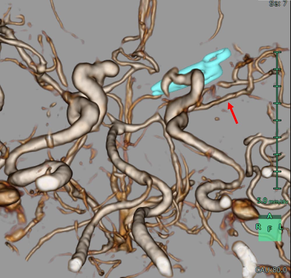 図2．頭部CTA 3D再構成