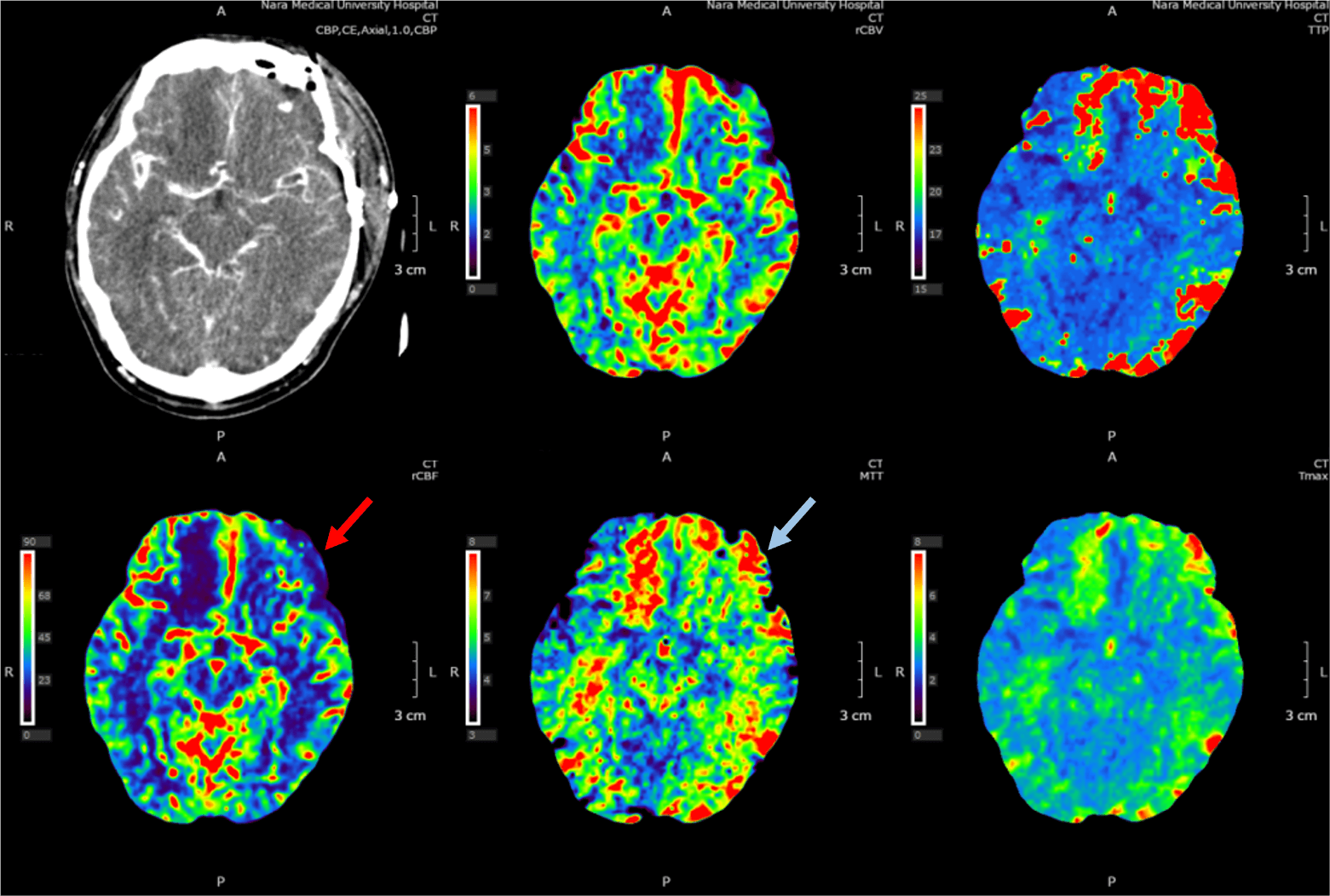 図3．頭部CT perfusion