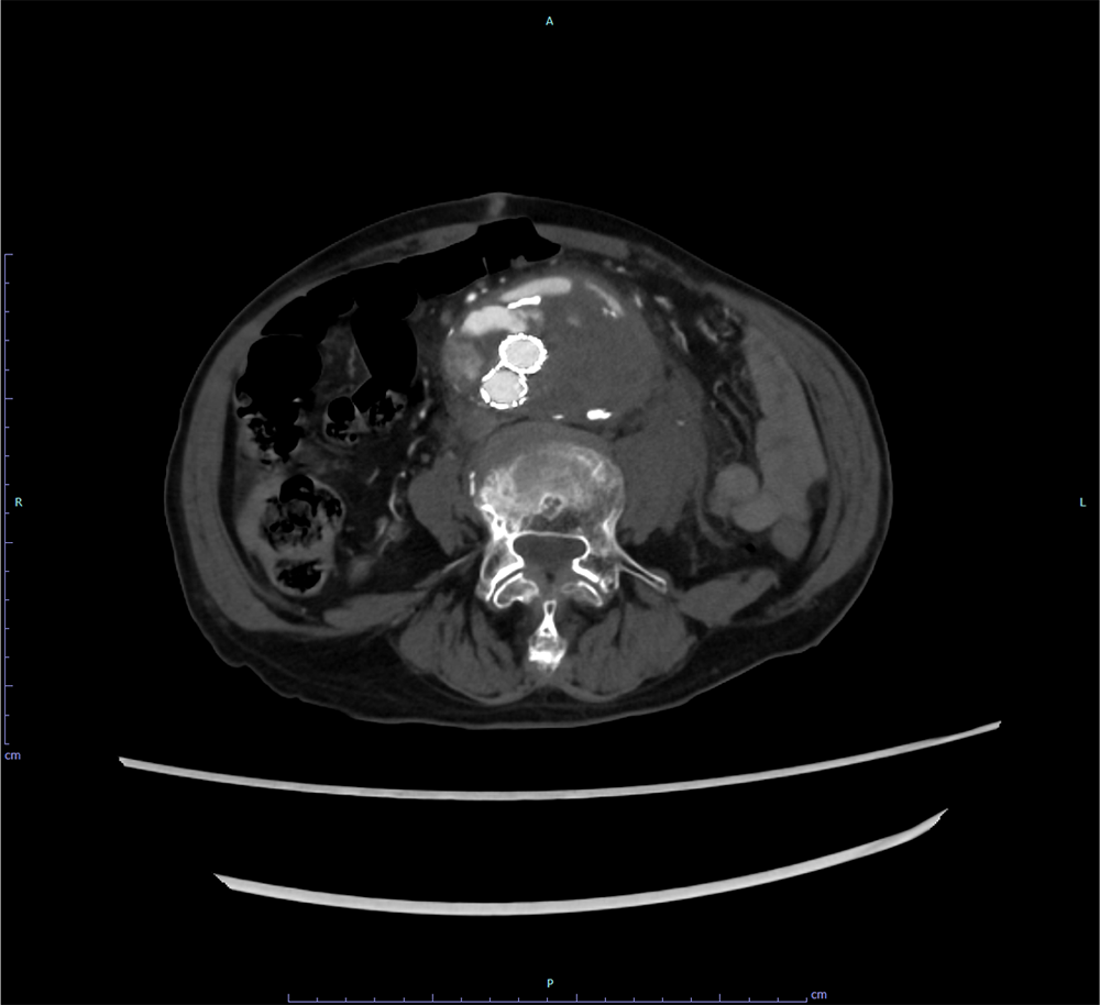 図1．治療前　造影CT 動脈相