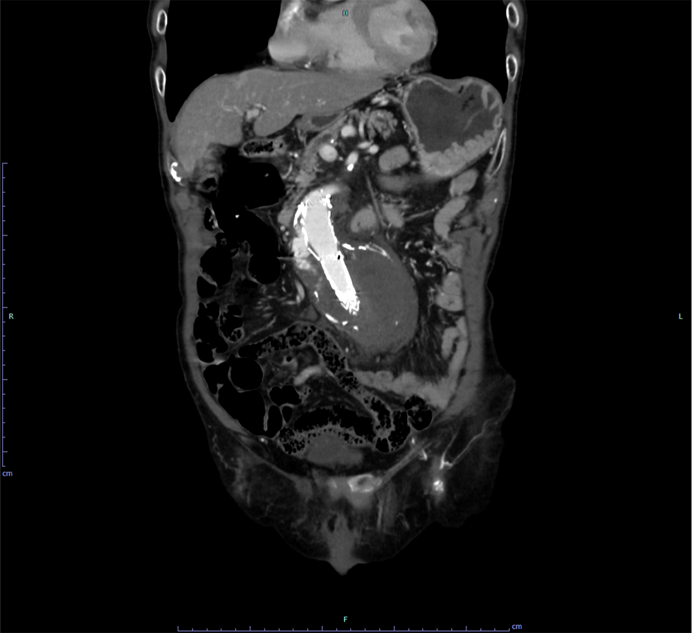 図2．治療前　造影CT 動脈相