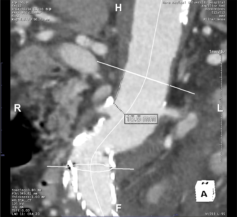 図3．治療前　造影CT 動脈層　MPR（Multi Planar Reconstruction）像