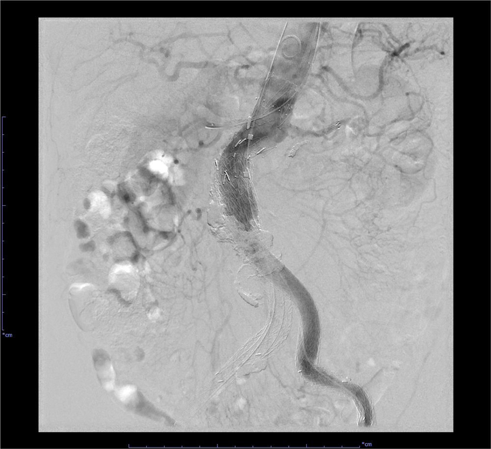 図4．血管造影　ステントグラフト留置後　