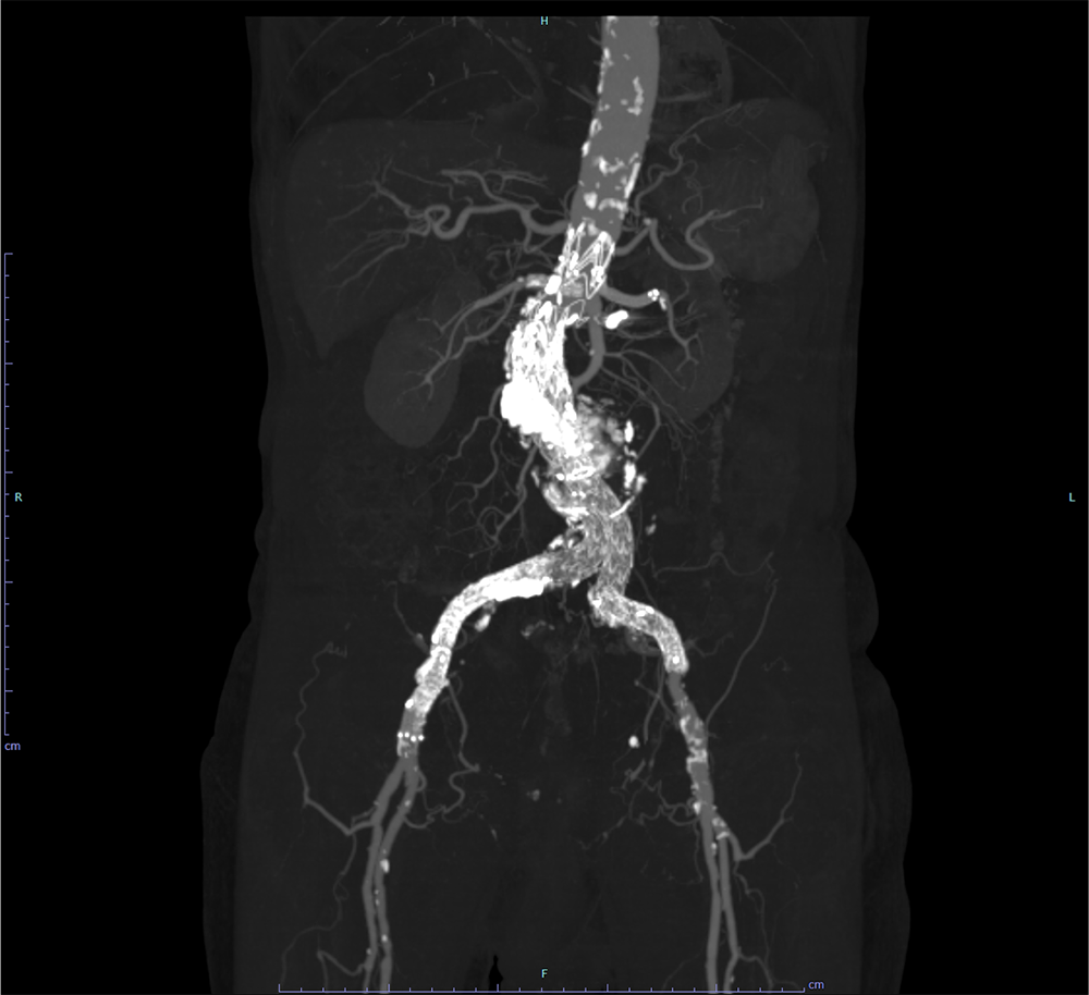 図5．治療後　単純CT
